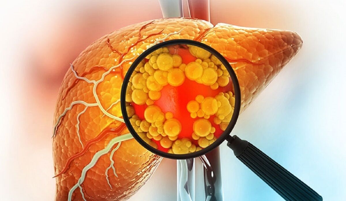 کبد چرب چیست؟ چگونه پیشگیری کنیم؟
